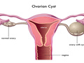 女性多囊卵巢是什么病引起的?还可以怀孕吗?