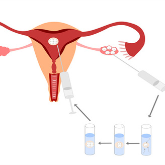 女性不孕不育的主要症状与治疗前景