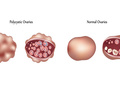 卵巢长什么样?卵巢多囊症是什么原因造成的?影响怀孕吗?
