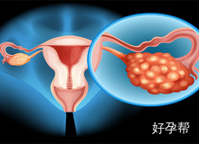 输卵管导丝介入：再次堵塞的风险与术后卧床休息的重要性