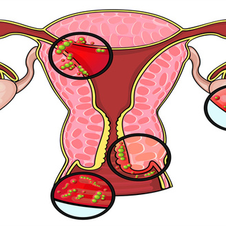 女性输卵管粘连要怎样治疗?女性输卵管粘连能怀孕吗?