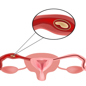 女性疏通输卵管痛吗?疏通后多久能备孕?你想知道的都在这里!