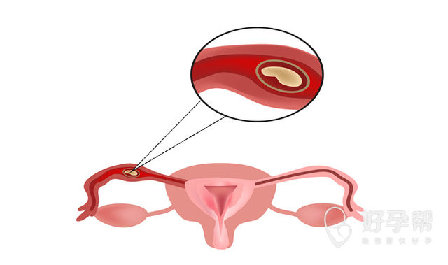 女性疏通输卵管痛吗?疏通后多久能备孕?你想知道的都在这里!