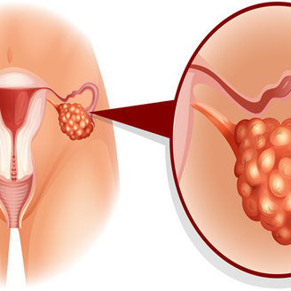女性多囊卵巢是怎么引起的?揭秘多囊卵巢综合症的原因!