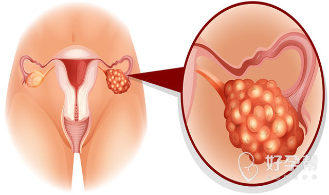 女性多囊卵巢是怎么引起的?揭秘多囊卵巢综合症的原因!