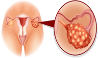 女性多囊卵巢是怎么引起的?揭秘多囊卵巢综合症的原因!