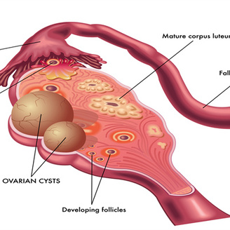 多囊卵巢综合症：症状与生育能力探讨