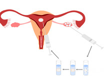 子宫内膜厚的原因及刮宫手术的必要性