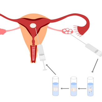 子宫内膜厚是什么原因造成的?影响试管移植吗?