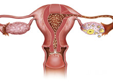 试管婴儿胚胎是怎么移植到子宫的?取卵后几天移植最好?