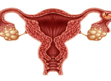 多囊卵巢最快受孕方法：试管婴儿与综合调理，迎接健康宝宝!