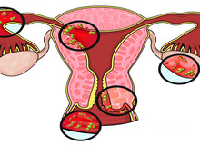 备孕指南：女性输卵管炎症——药物治疗与手术治疗的选择