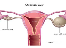 不孕科普：多囊卵巢综合症检查方法及诊断流程详解