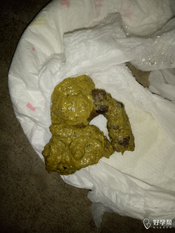 请问医生一周岁的宝宝拉这种大便是消化不良吗?