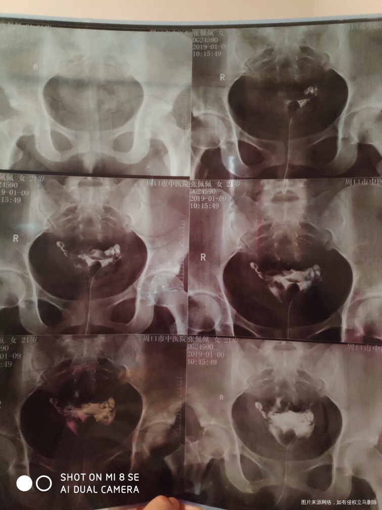 帮忙看一下 输卵管有什么问题吗