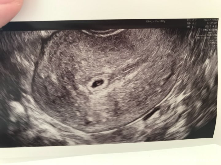 移植第二十天阴部B超