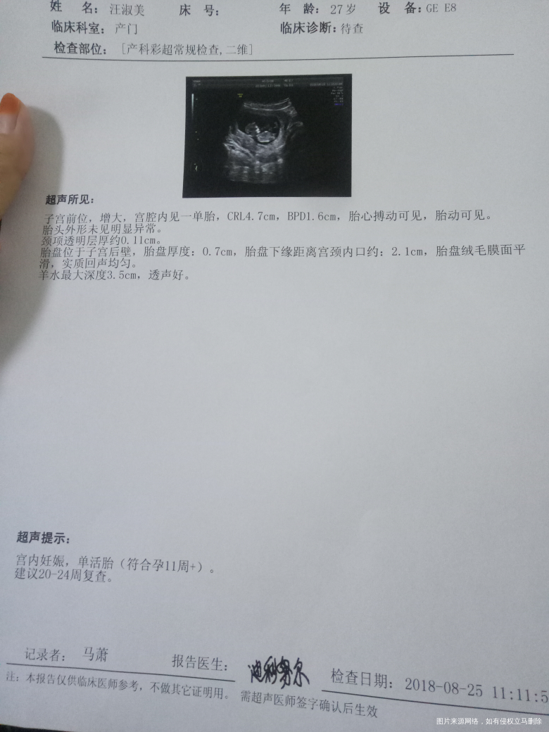 今天去做nt了,麻烦医生看下正常吗?