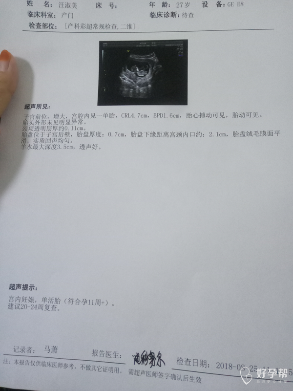 今天去做nt了,麻烦医生看下正常吗?
