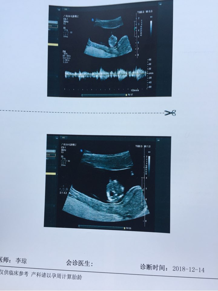 看下nt结果13周怀孕