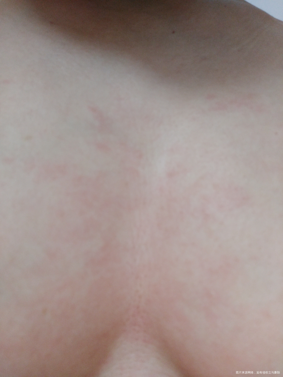 怀孕六个多月,胸前和肚子痒痒的,红红的,