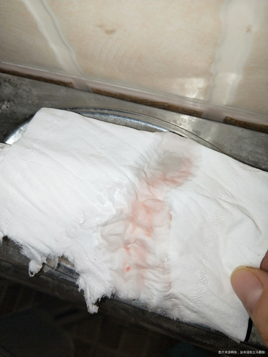 本日21号移两囊,今天27号六天了,见了点红