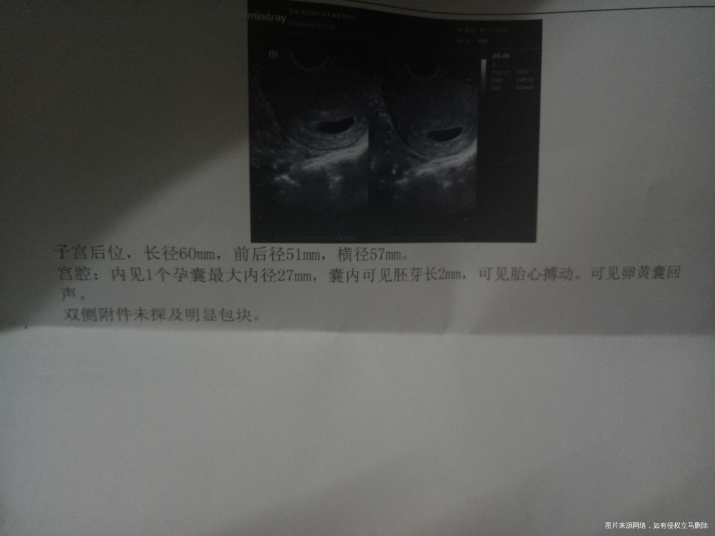 孕9周了,孕酮25,hcg8万多,怎么办?会不会流产啊