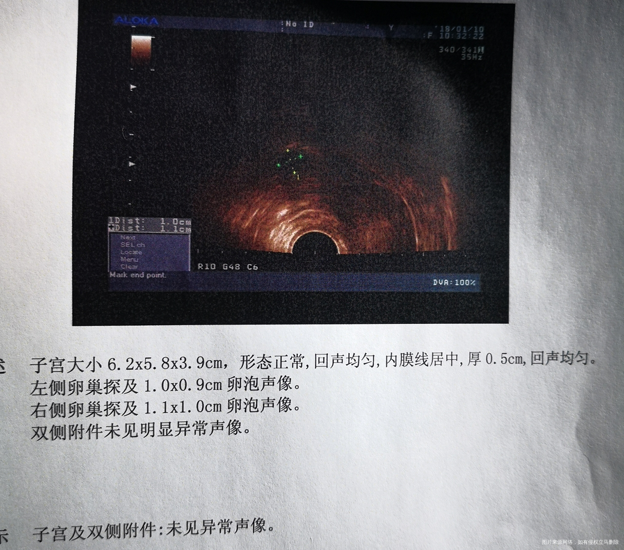 医生说卵泡小,卵泡小能受孕吗?