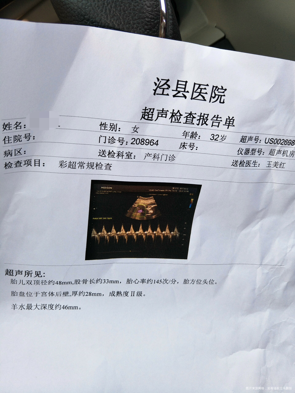 怀孕21周B超图,宝宝的俩腿中间有个点是男宝吗?