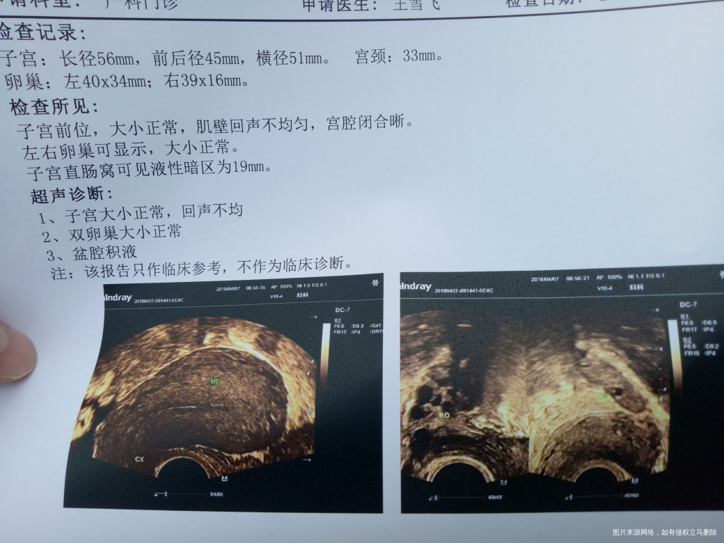 产后复查,预约了今天的阴超