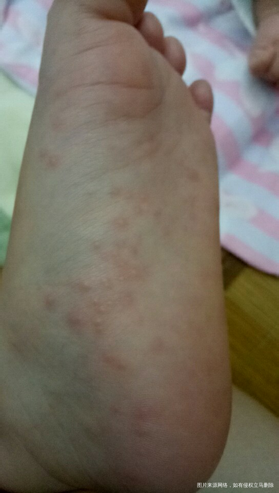 请问医生,宝宝手脚上长的是什么?