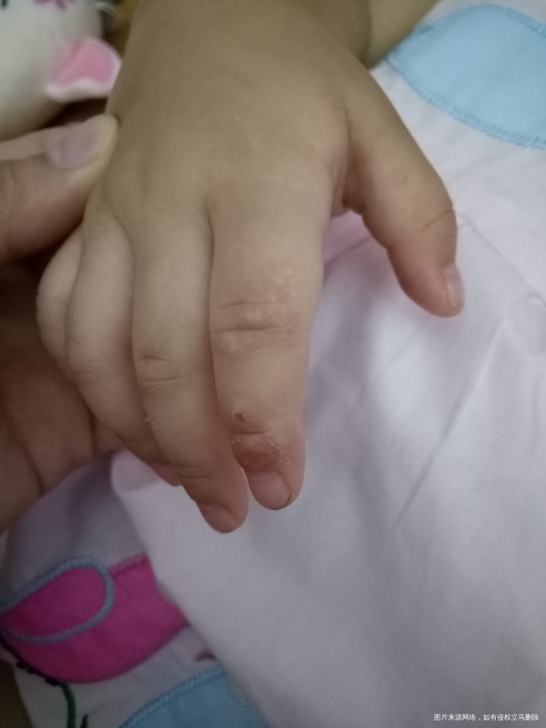请问医生,宝宝手脚上长的是什么?