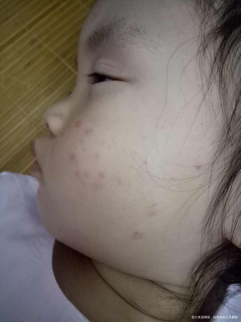 请问医生,宝宝手脚上长的是什么?