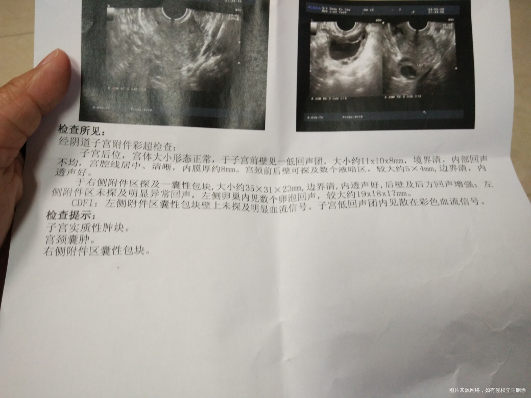 多囊卵巢泡泡自己成熟了