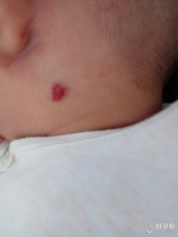 宝宝耳朵后面得血管瘤用什么方法去掉?
