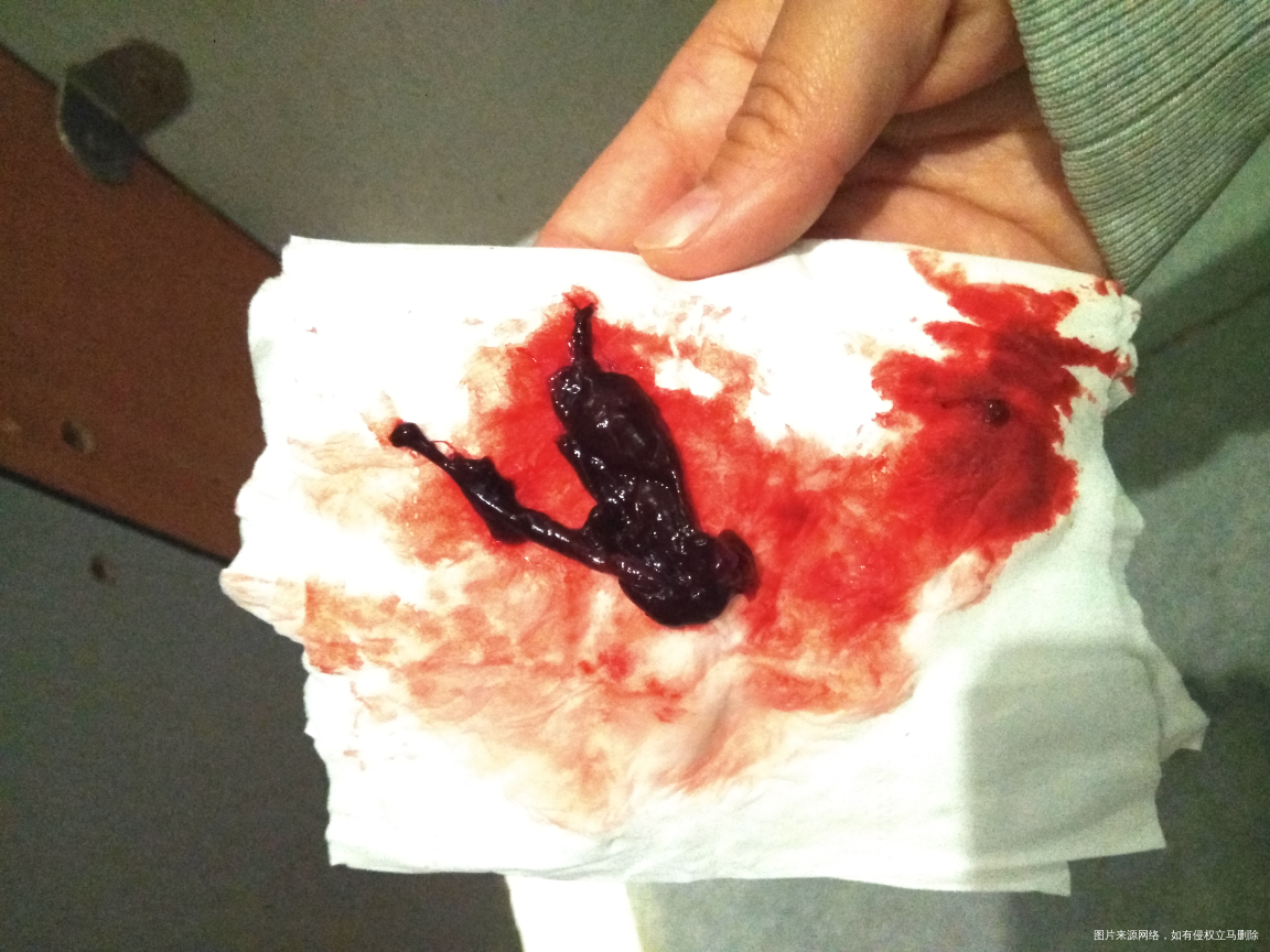 您好,这个血块2倍的量一次出来,这是月经