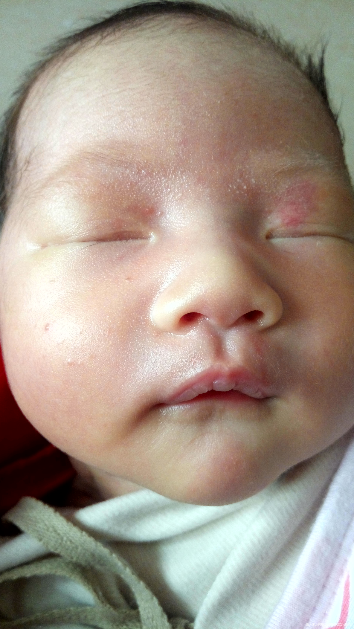 麻烦进来帮忙看看是胎记还是血管瘤