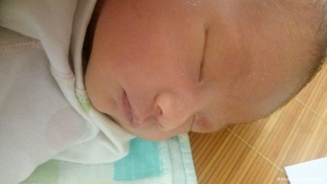 麻烦进来帮忙看看是胎记还是血管瘤