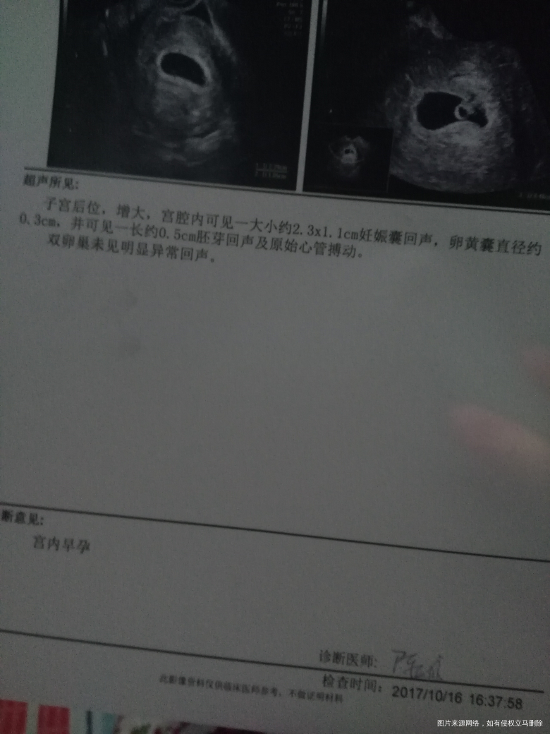 孕45天,今天阴道有出血,做了个彩超