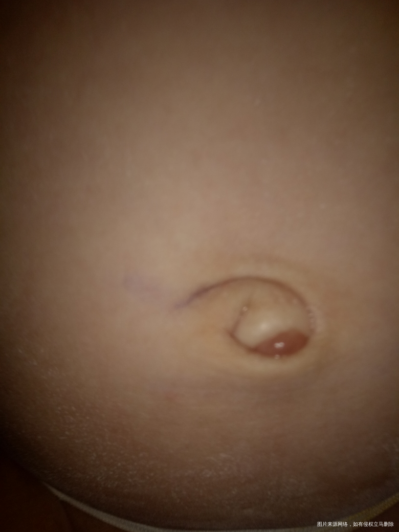 肚脐眼不知道怎么长了个东西