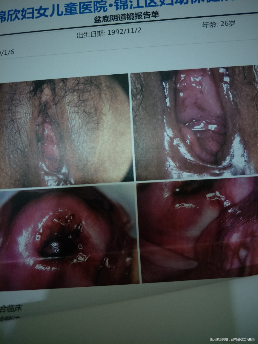 有产后阴道壁脱垂和腹直肌分离的姐妹吗