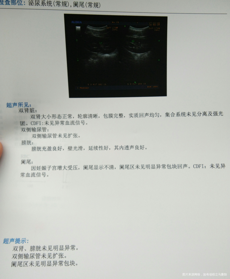 孕21+2,右小腹及后腰疼痛