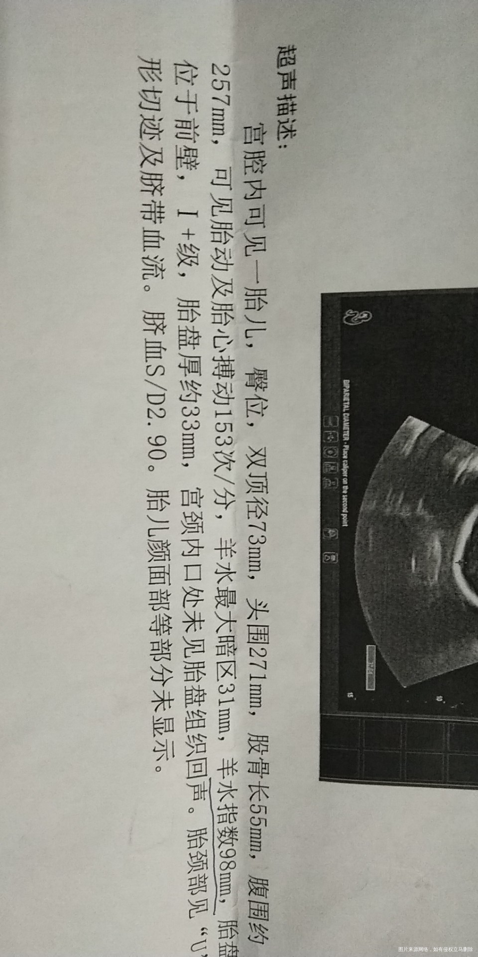 33周 胎位不正 胎儿头向上。