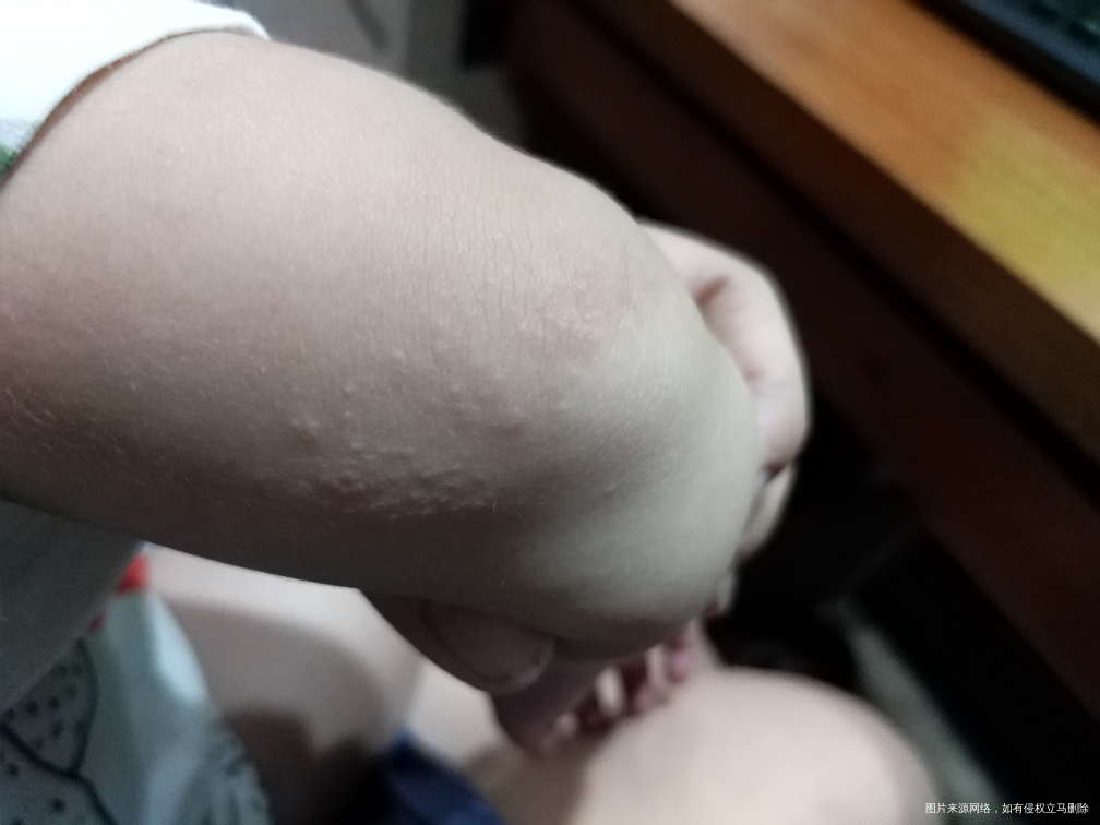 请医生帮我看看孩子这长的什么