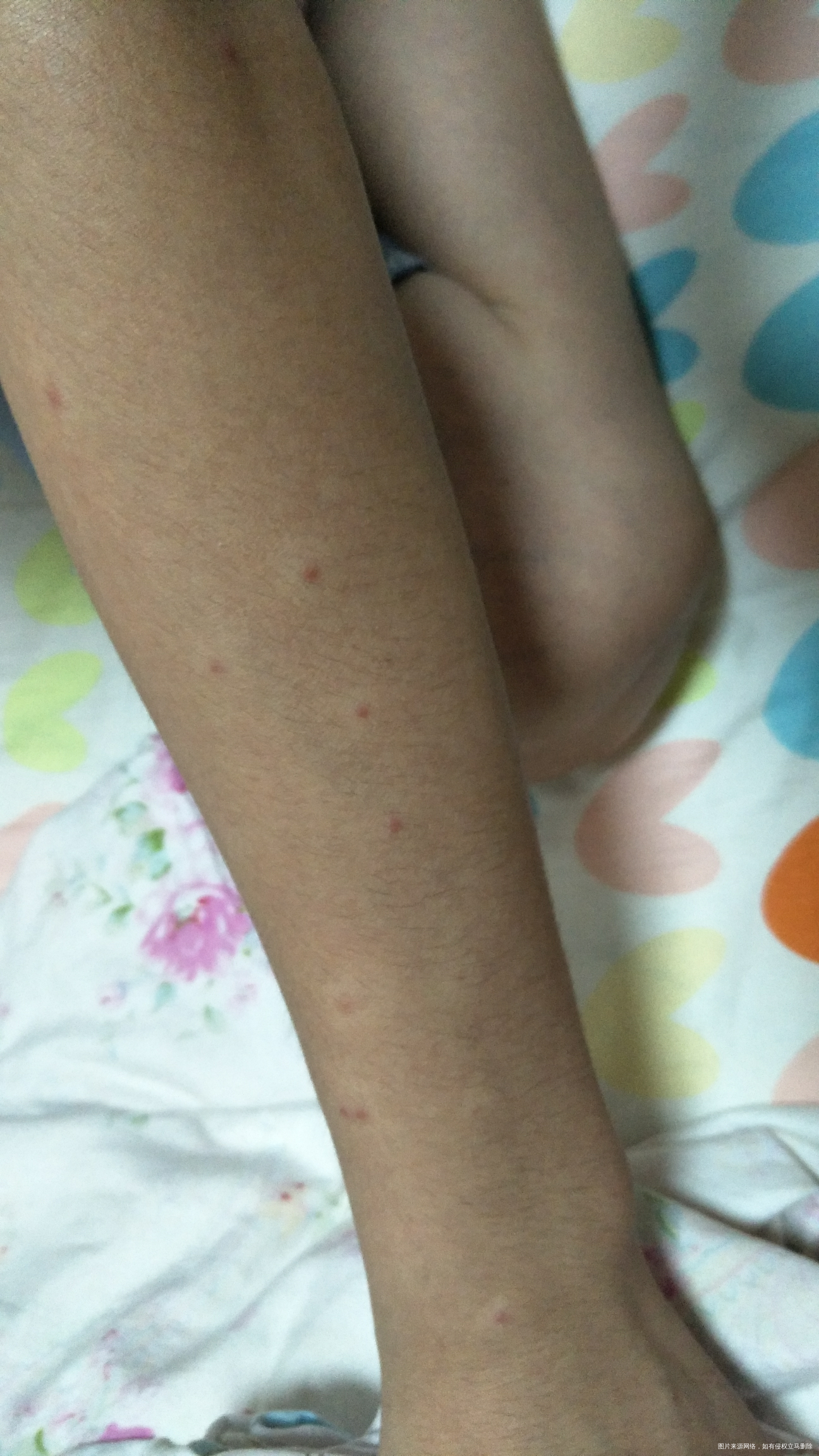 小朋友手上突然长这么多的小红点,怎么回事啊?