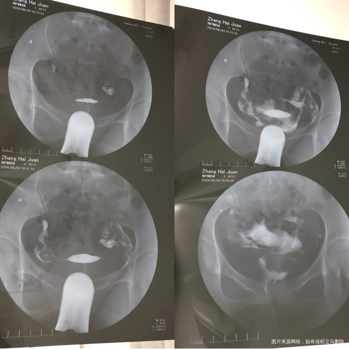 月经不调,输卵管造影通而不畅