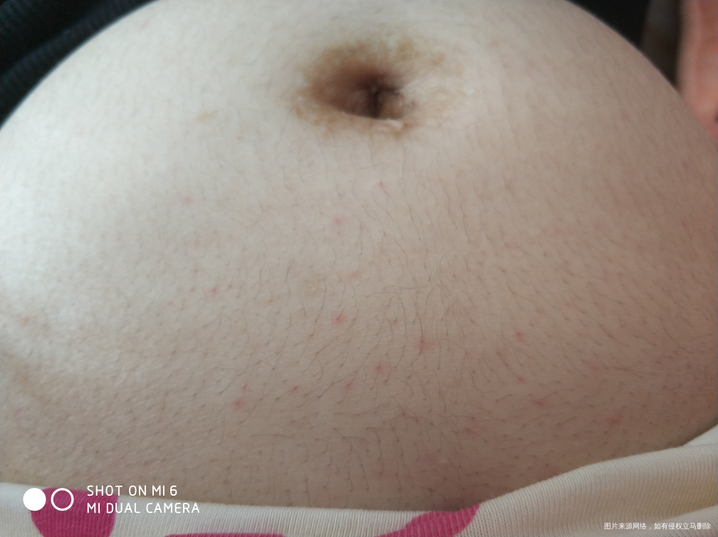 怀孕16周肚子上有好多红疙瘩