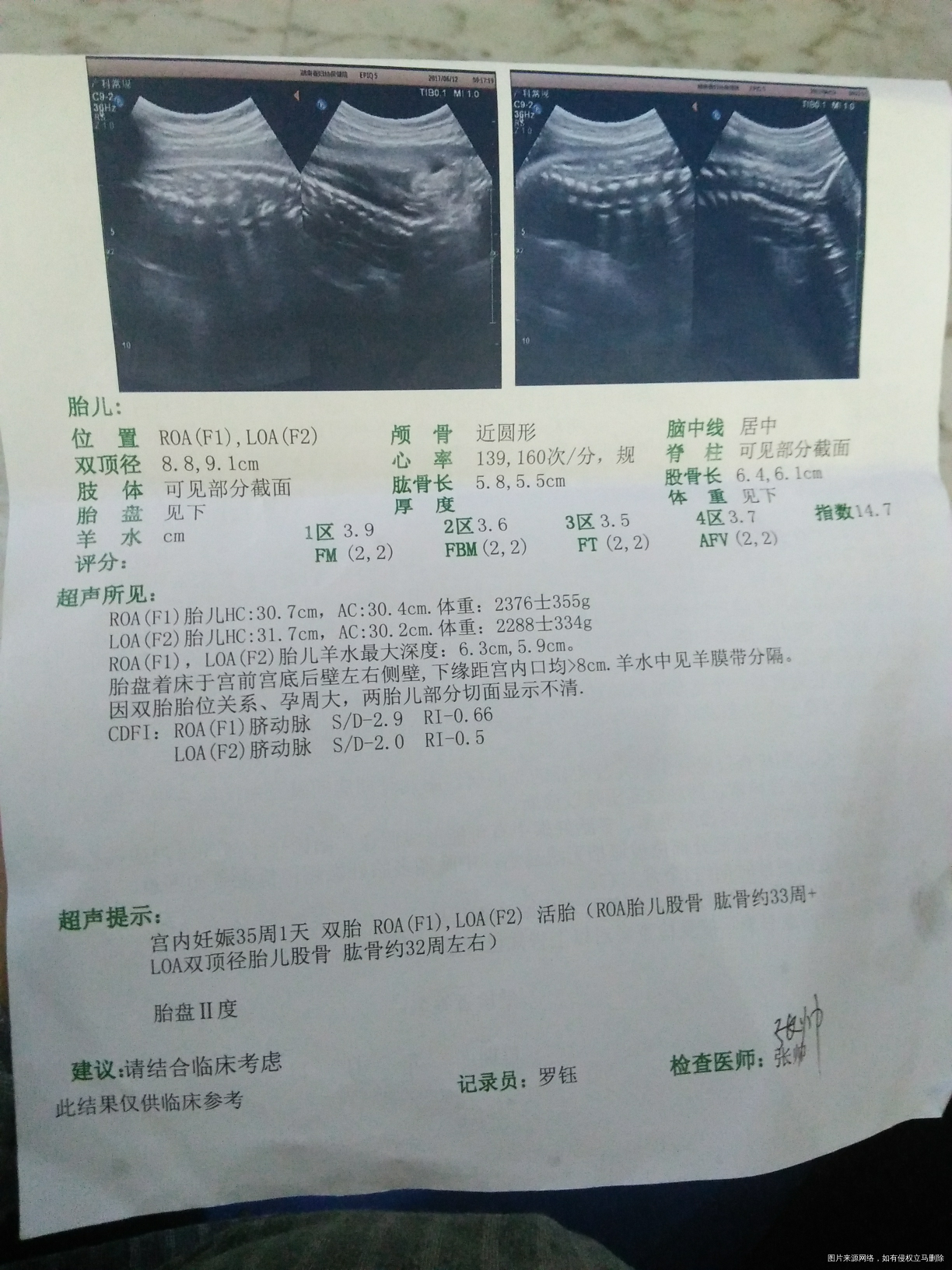 双胎孕35周+1,请医生帮忙分析下彩超及验血结果,谢谢