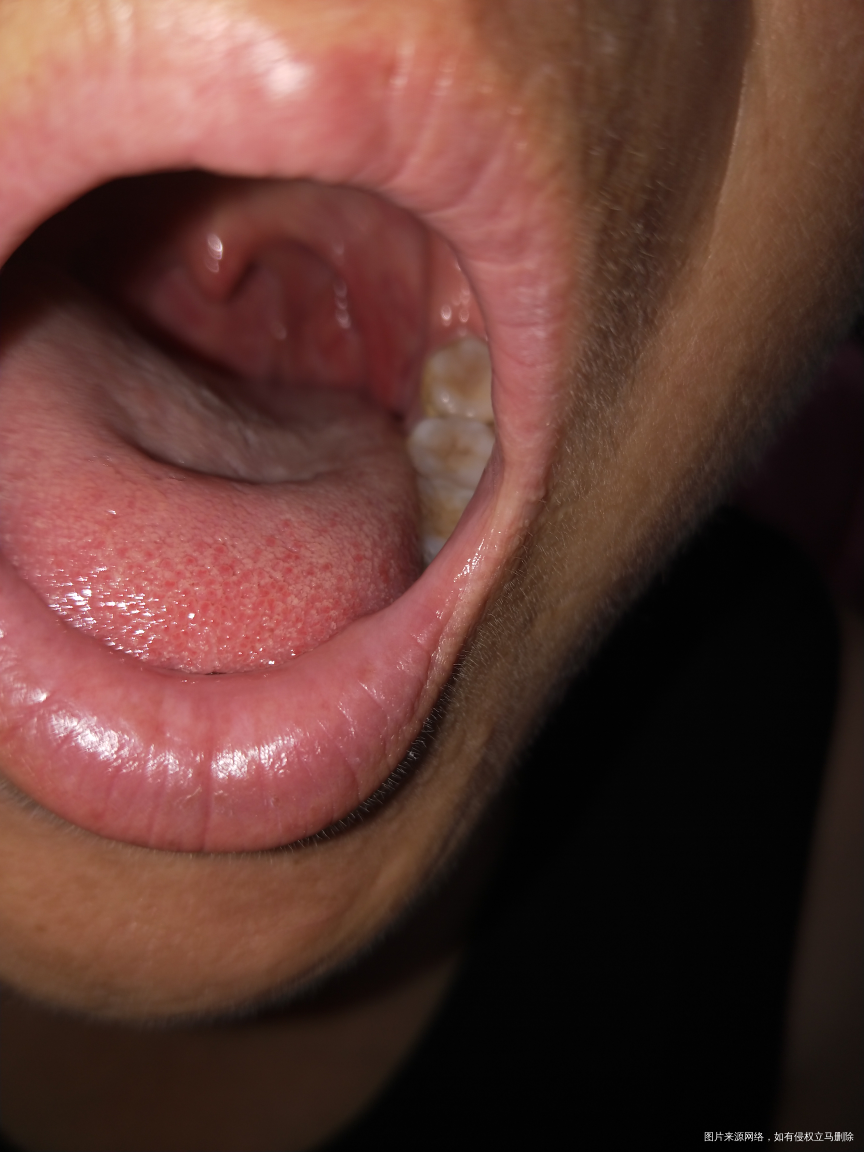 请帮忙看一下,嗓子是怎么回事啊!