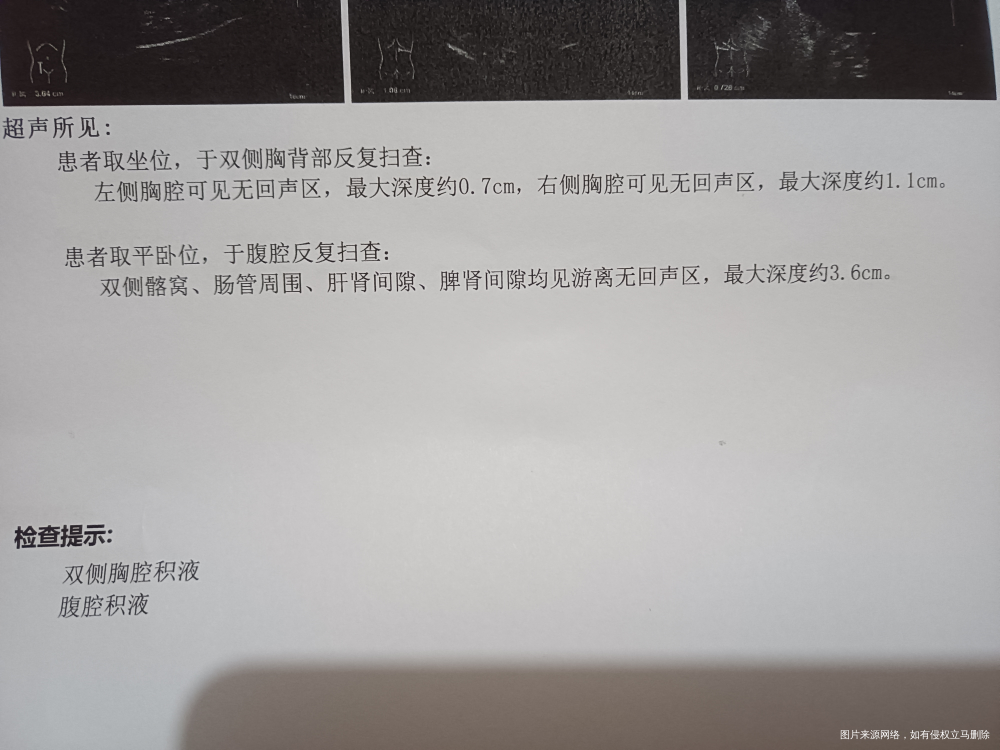 取卵第三天有腹水,严重吗?