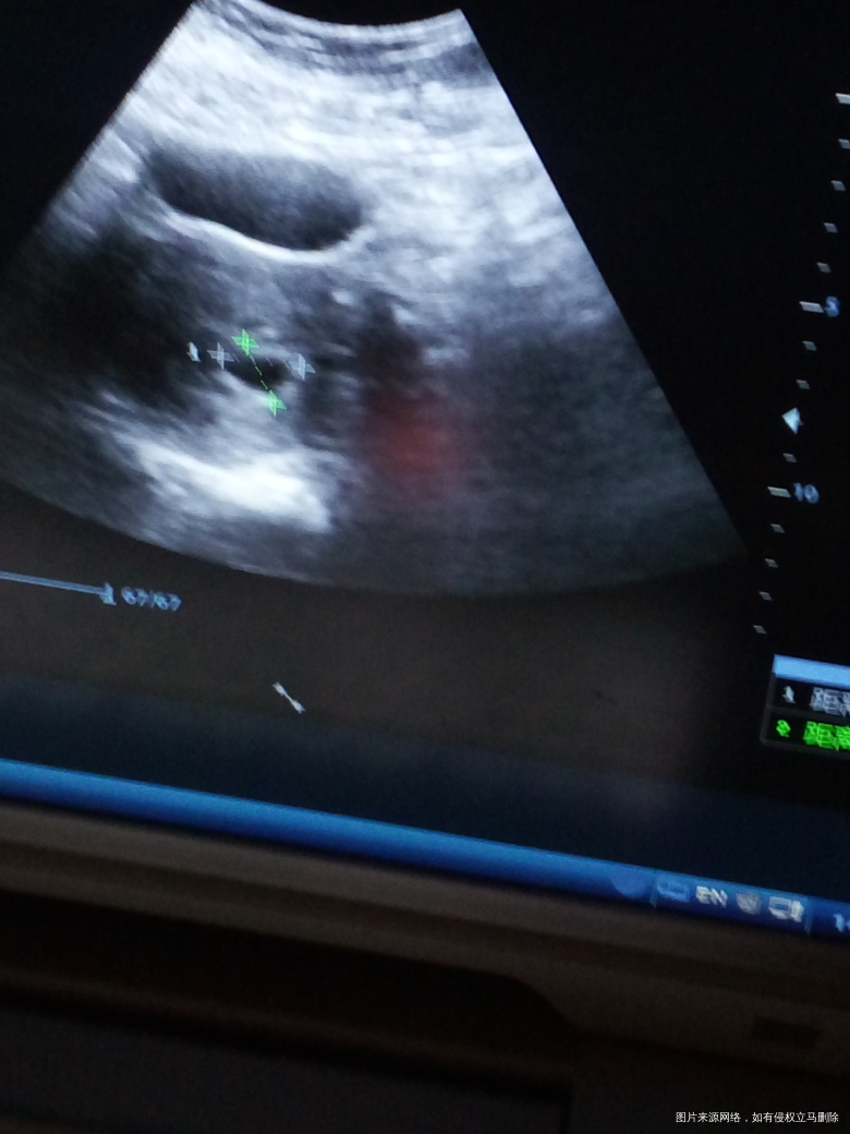 下午检查的,一直孕酮低